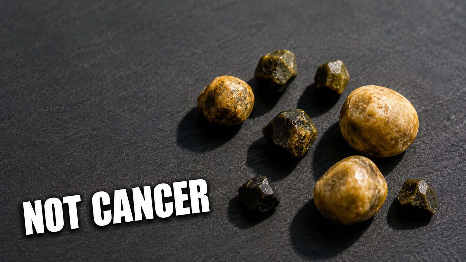 Macro close-up of several extracted gallstones of varying size, color