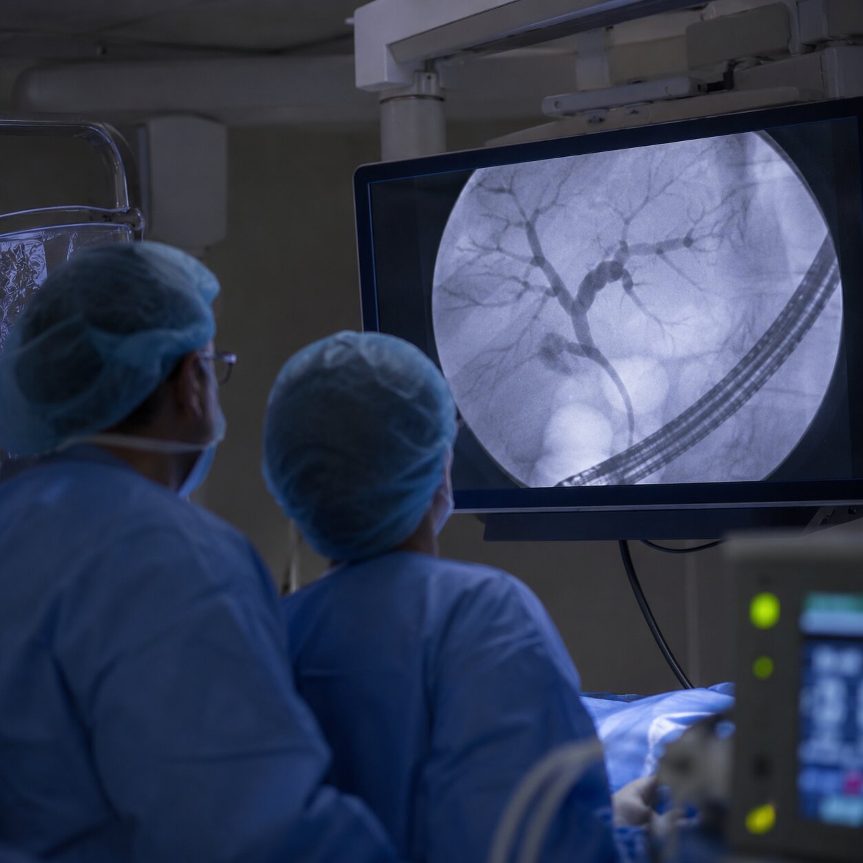 Gastroenterology team in a procedure room working beside a live fluoroscopy monitor during a bile duct stone removal
