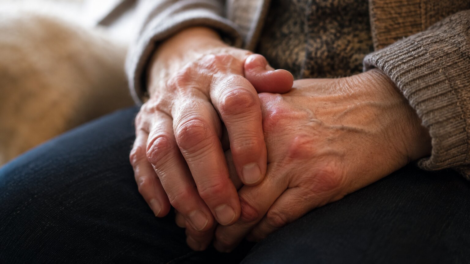 Close-up of a person's hands showing visible joint swelling consistent with chronic autoimmune inflammatory disease