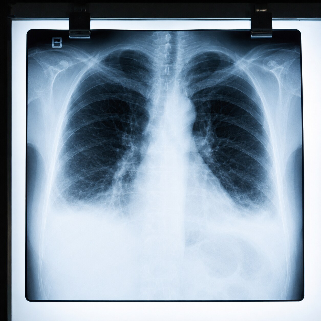 Chest X-ray film displayed on a lightbox showing hazy fluid patterns in the lower lung fields consistent with fluid overload