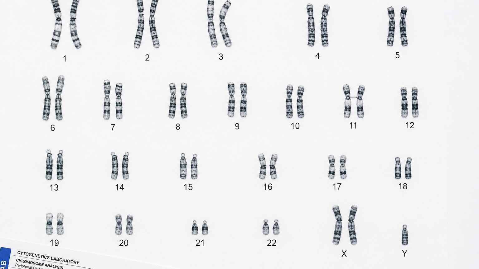 Laboratory karyotype image showing 23 paired chromosomes arranged and numbered from an adult blood sample