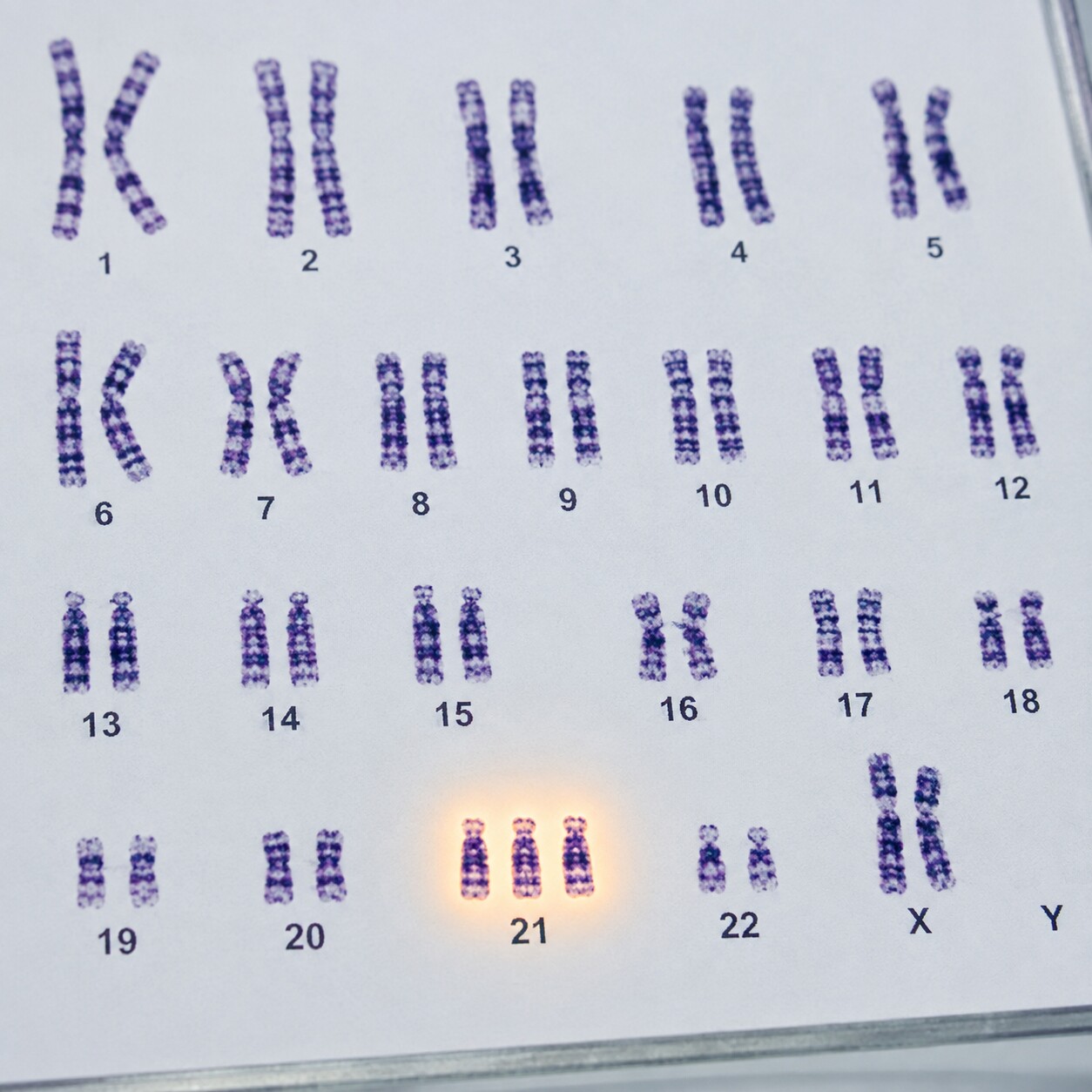 Laboratory karyotype image showing three copies of chromosome 21 used to diagnostically confirm Down syndrome in a symptomatic newborn