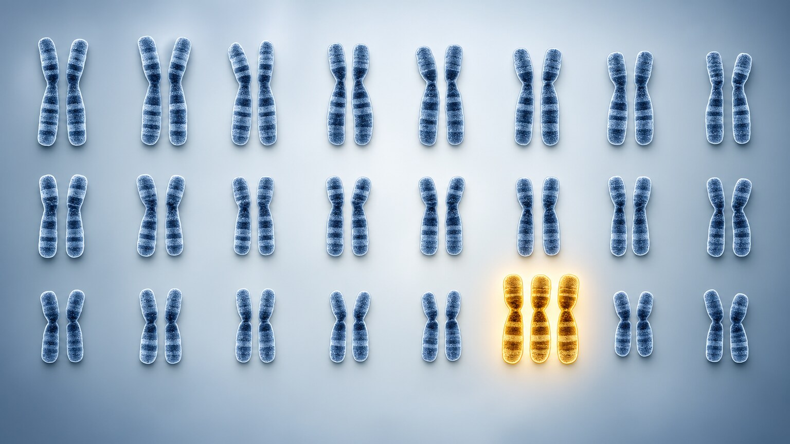 Scientific illustration of a chromosome set showing one extra chromosome, consistent with a trisomy pattern flagged on prenatal screening