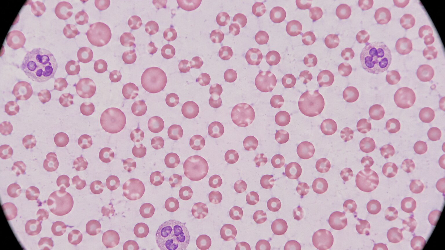 Microscope view of a blood smear showing red blood cells of clearly uneven size, some large and some small