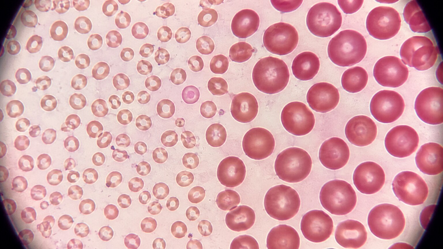 Side-by-side scientific illustration comparing small pale microcytic red blood cells with larger normal red blood cells