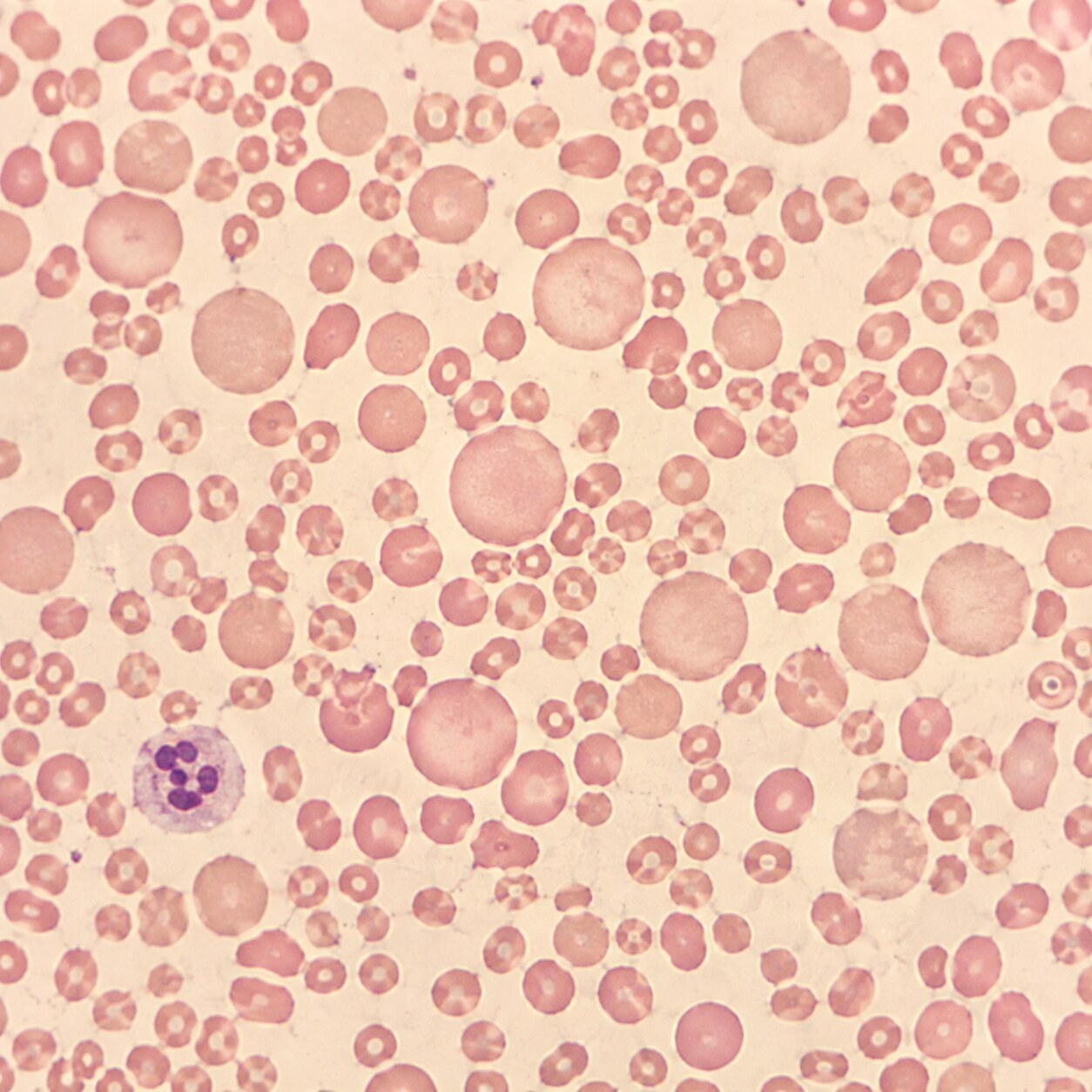 Blood smear microscope field showing a dimorphic mix of both small pale cells and large round cells in the same sample