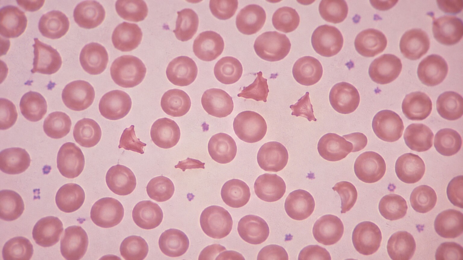 Microscope view of a stained blood smear showing helmet-shaped and triangular red blood cell fragments among normal round red blood cells