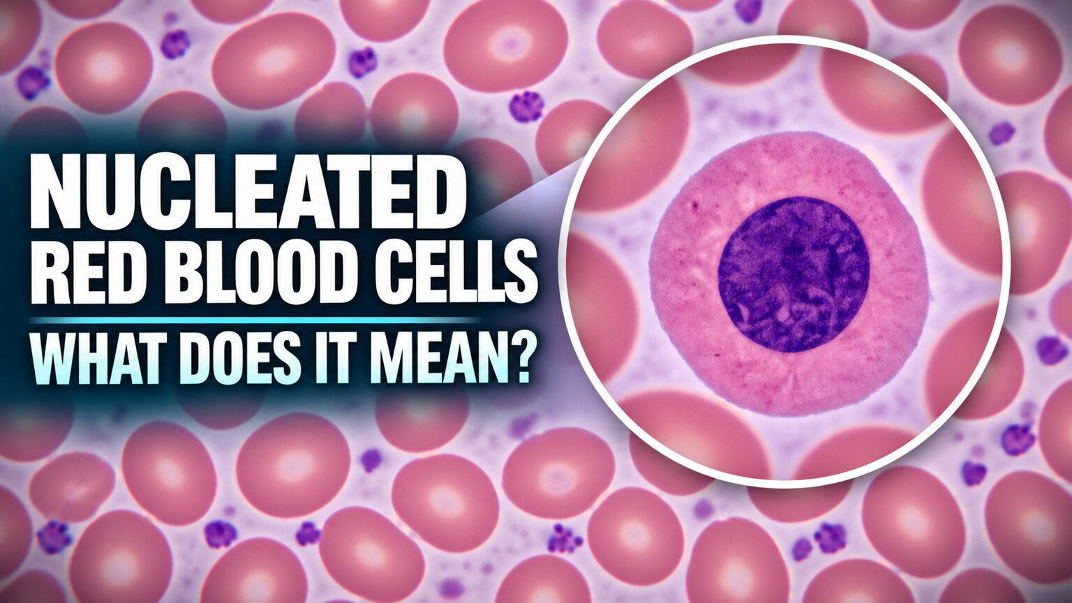 Microscope view of a nucleated red blood cell with a dense round purple nucleus surrounded by normal mature red blood cells without nuclei