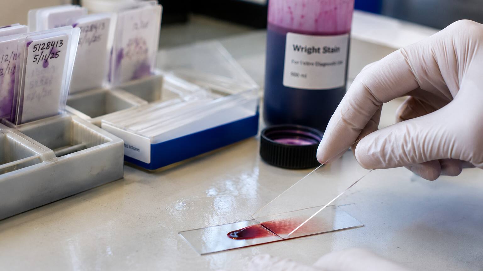 Laboratory technologist's hands using the wedge technique to spread a blood drop across a glass microscope slide