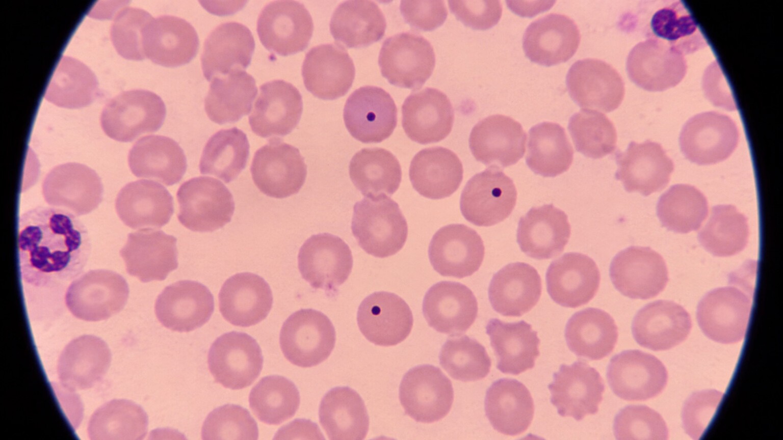 Close-up of a stained blood smear slide under a microscope's field of view, with several small dark Howell-Jolly bodies visible inside red blood cells