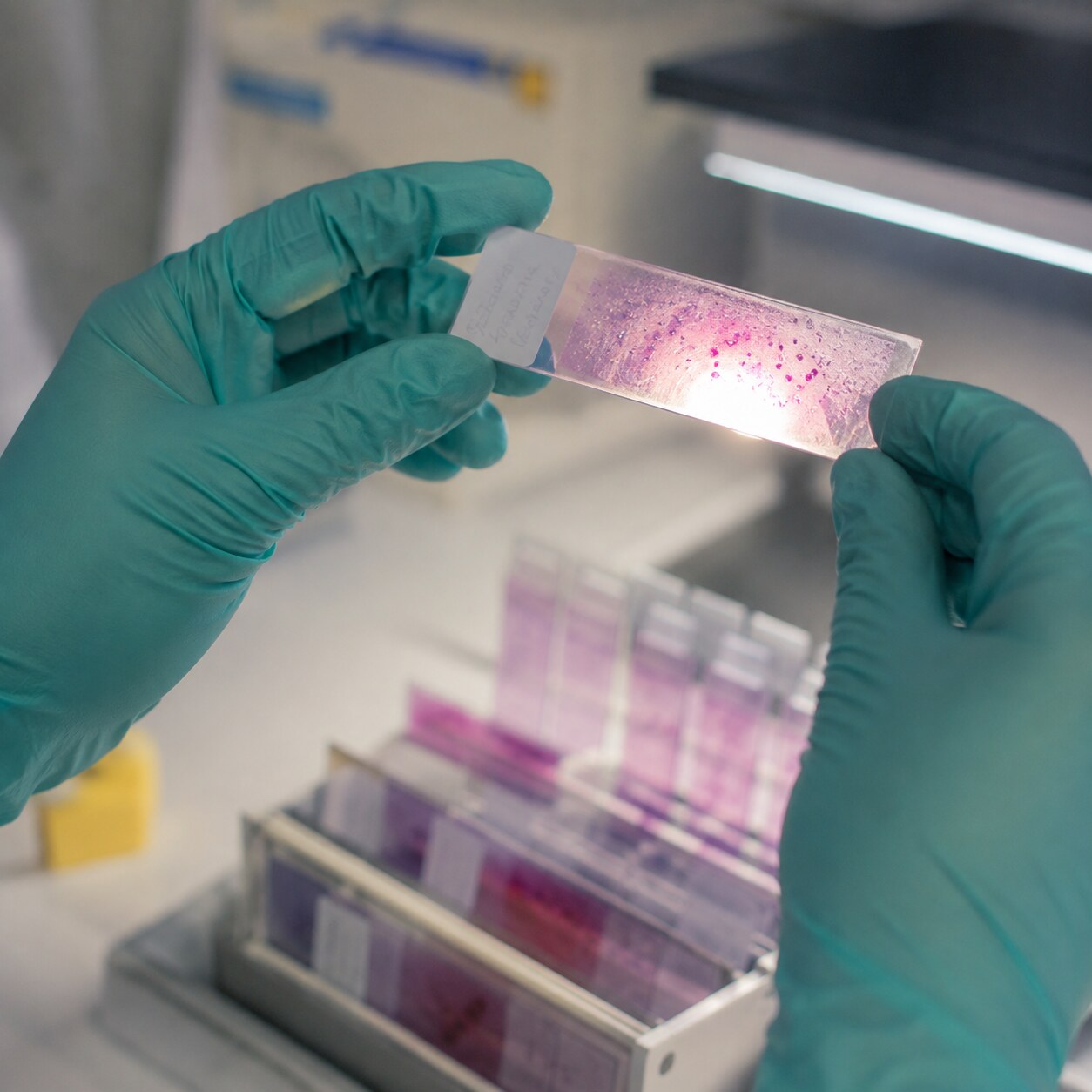 Laboratory technologist closely examining a stained blood smear slide to distinguish genuine toxic granulation from a staining artifact