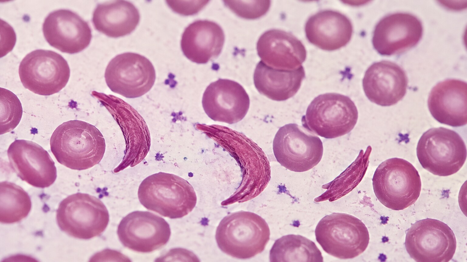 Microscope view of crescent-shaped sickle red blood cells scattered among round healthy red blood cells