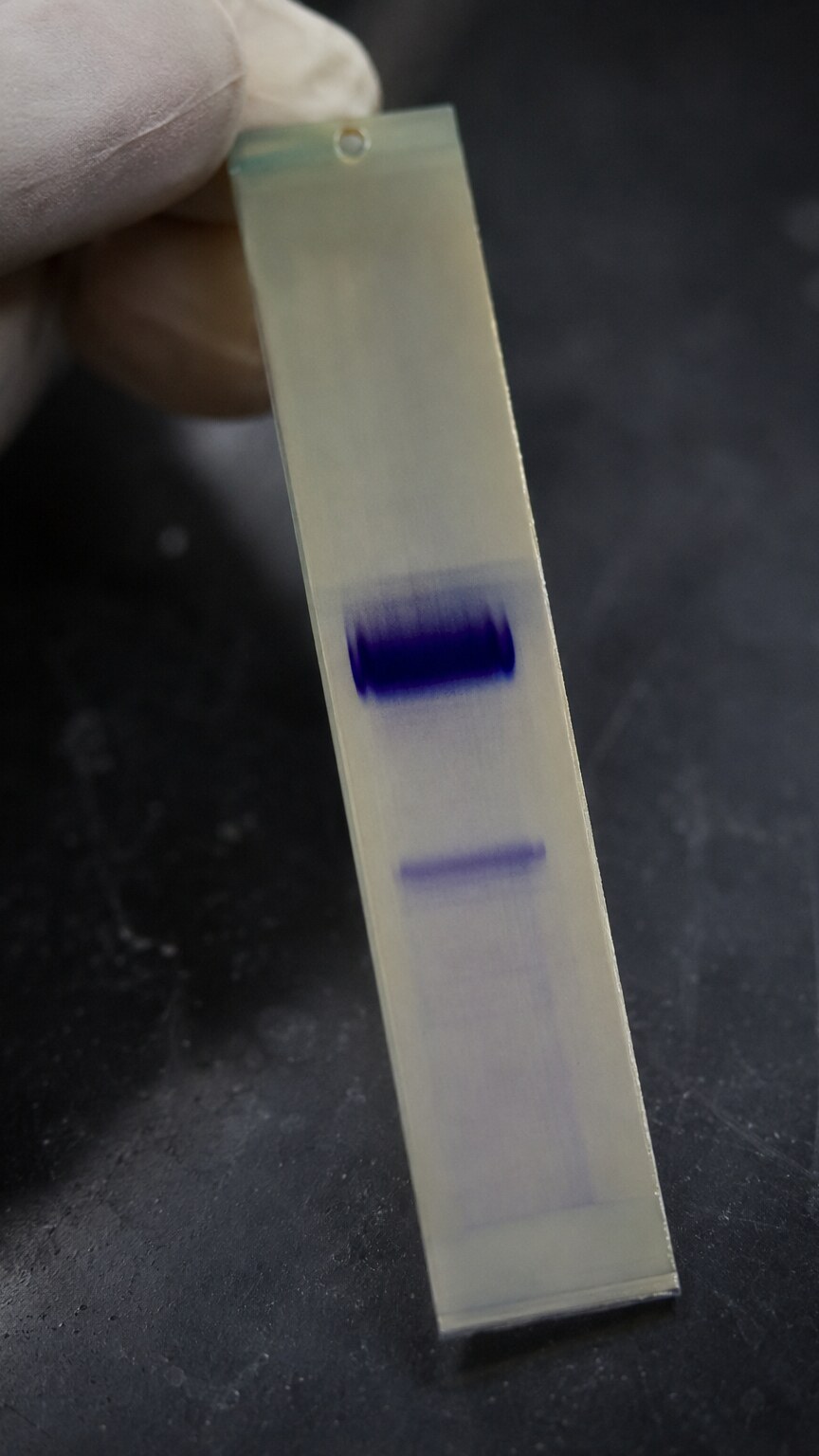 Close-up of a hemoglobin electrophoresis test strip showing separate bands for hemoglobin A and hemoglobin S