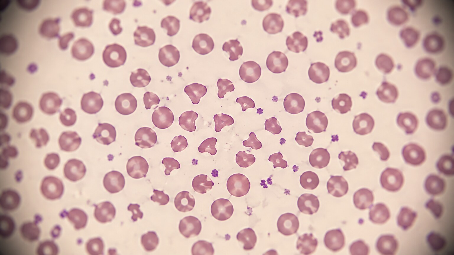Microscope view of a blood smear showing jagged, fragmented schistocyte red blood cells among normal round cells
