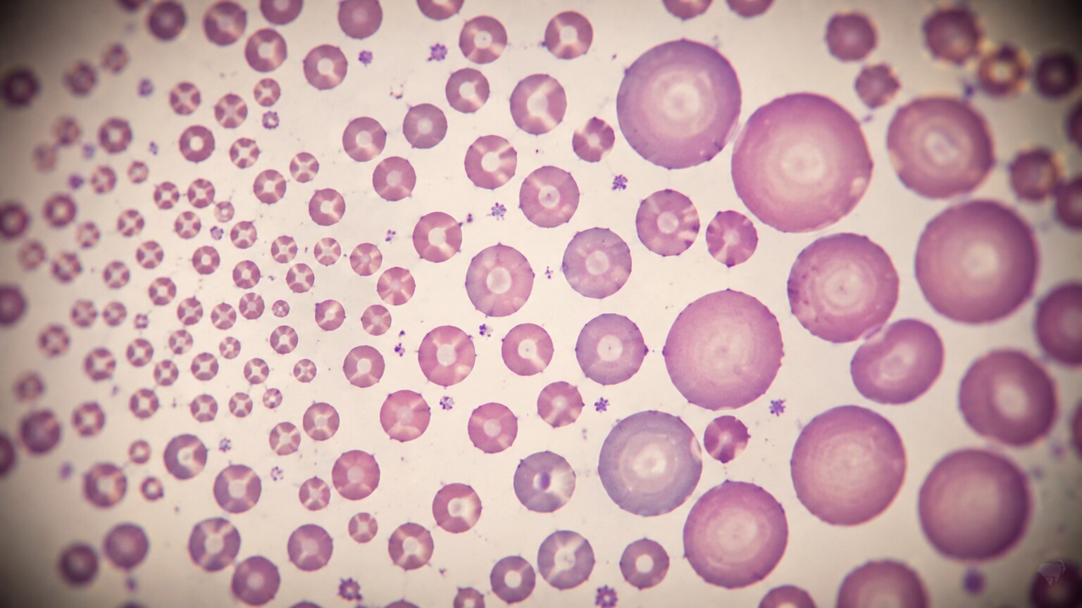 Microscope view of red blood cells varying noticeably in size, some abnormally small and others abnormally large