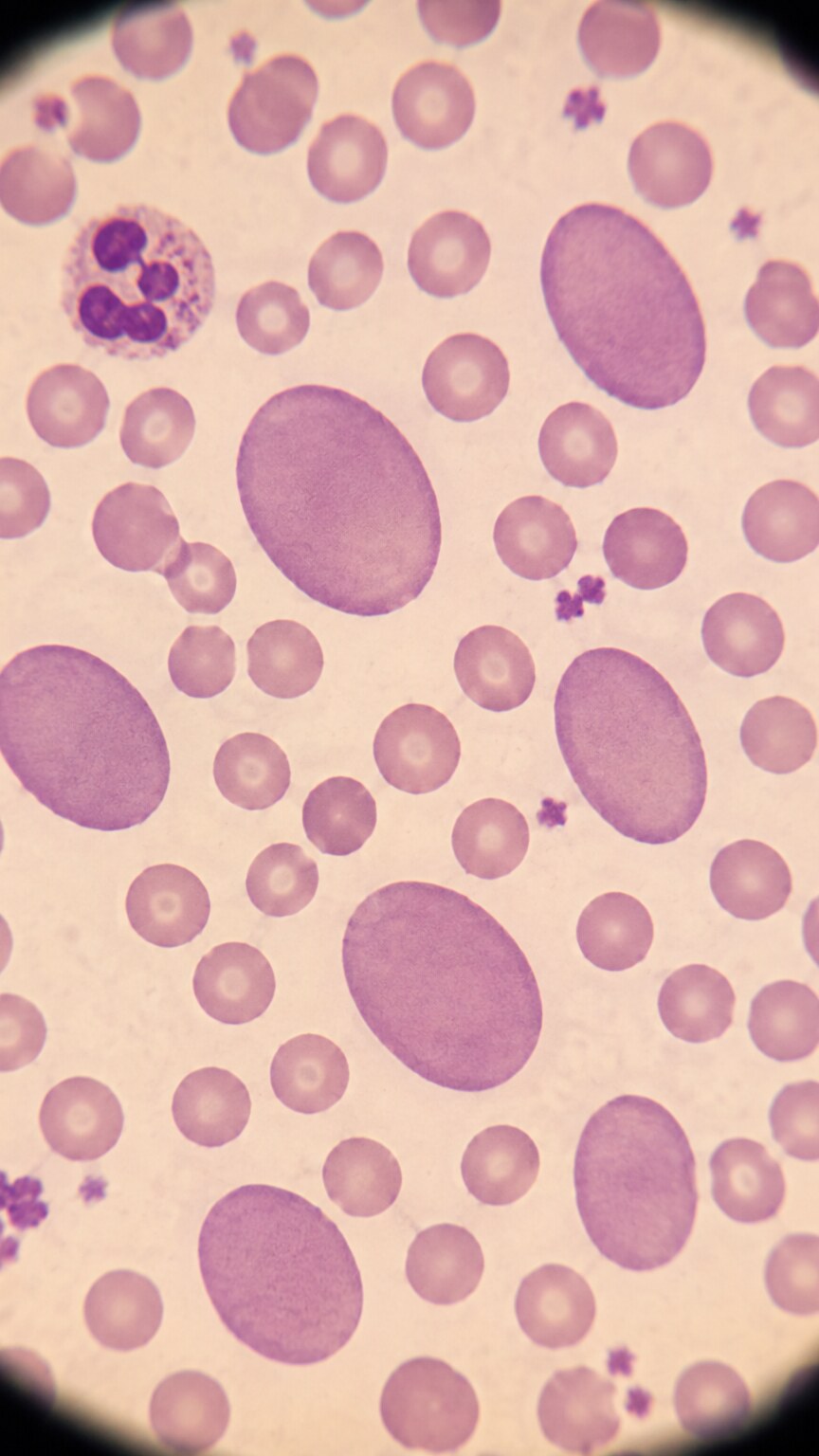 Microscope view of a blood smear showing several abnormally large, oval-shaped macrocytes among smaller normal red blood cells