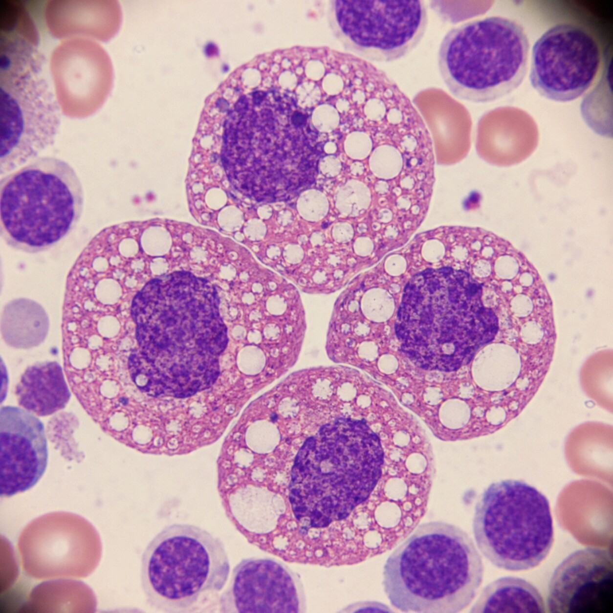 Microscopic illustration of bone marrow red blood cell precursors showing vacuoles caused by direct alcohol toxicity