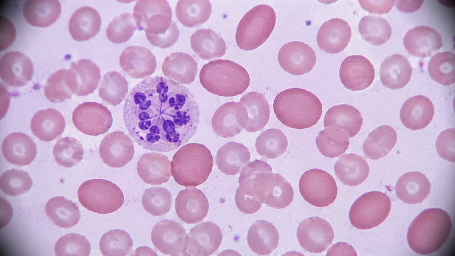 Close-up microscope view of a stained peripheral blood smear showing oval macrocytes and a hypersegmented neutrophil
