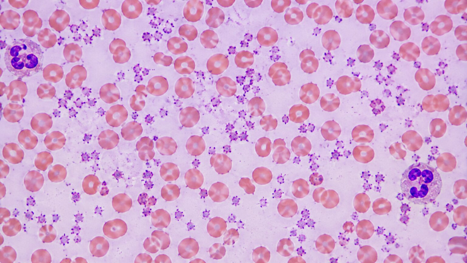 Magnified blood smear microscope view showing an unusually dense field of small purple-stained platelets among red blood cells