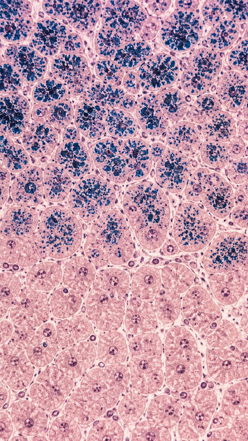 Portrait-oriented cross-section illustration of liver tissue showing dense iron deposits stained blue inside hepatocytes from hereditary hemochromatosis