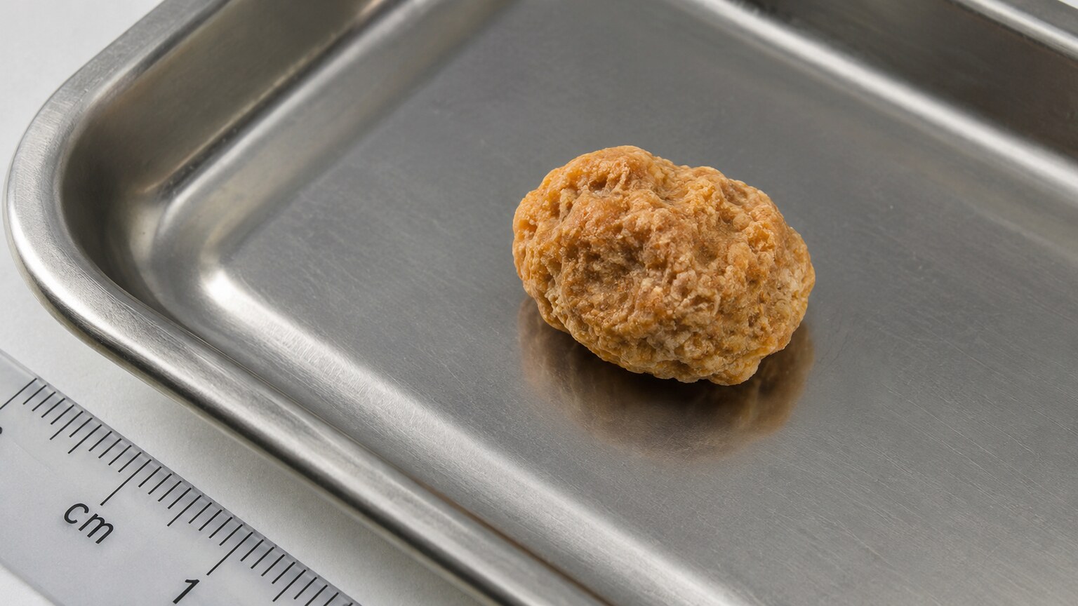 Close-up macro photograph of a small, rough-surfaced uric acid kidney stone resting on a clinical specimen tray