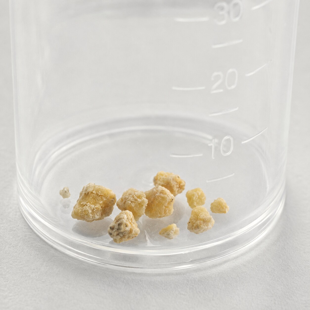Small kidney stone fragments resting in a clear urine collection cup used to determine stone composition