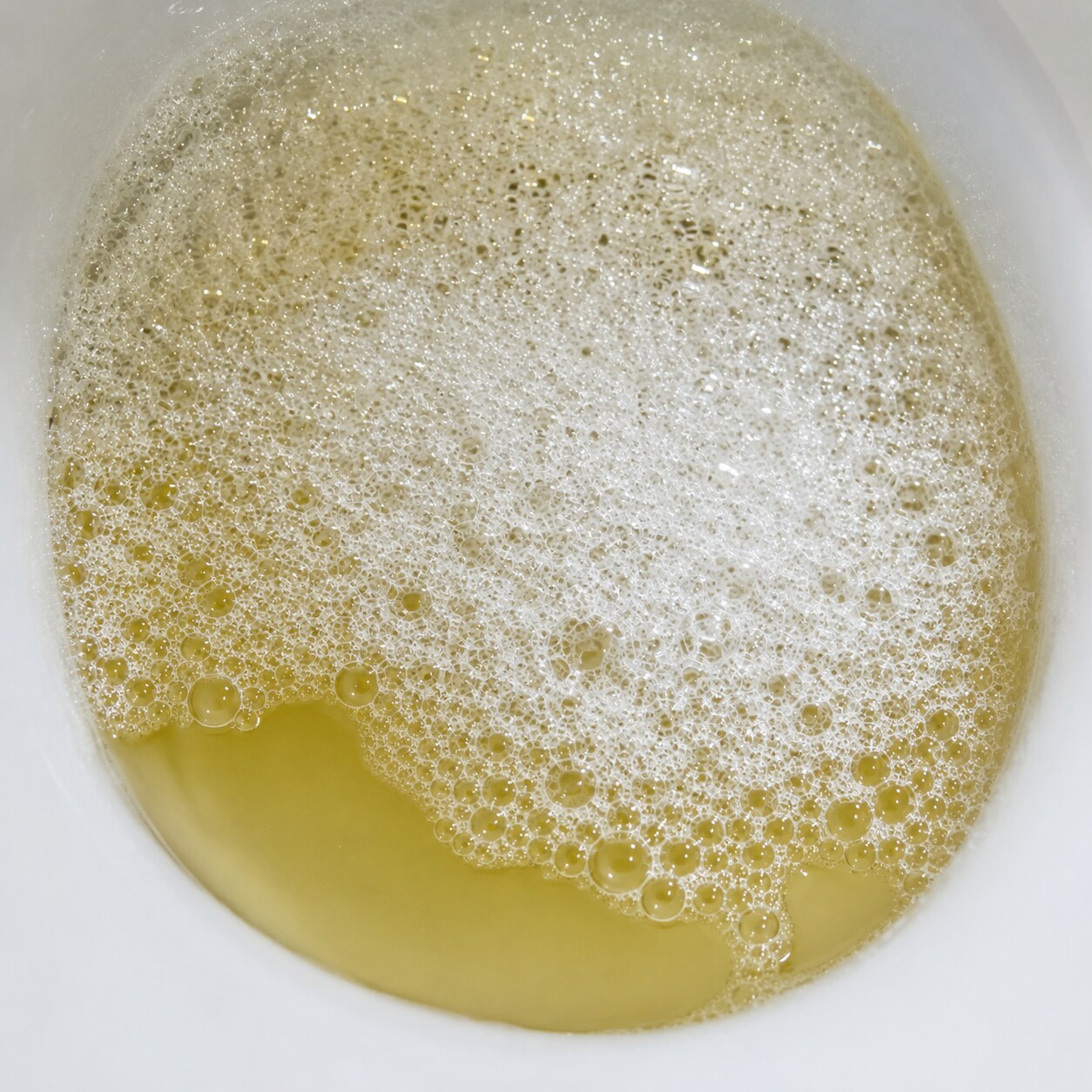 Close-up of visibly foamy, bubbly urine in a toilet bowl, a recognizable sign of significant protein loss through the kidneys