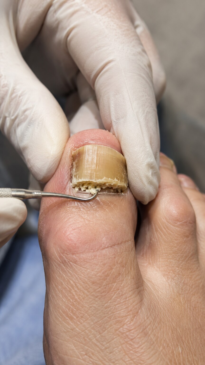 Close-up of a gloved hand using a small curette to collect crumbling debris from beneath the edge of a discolored toenail