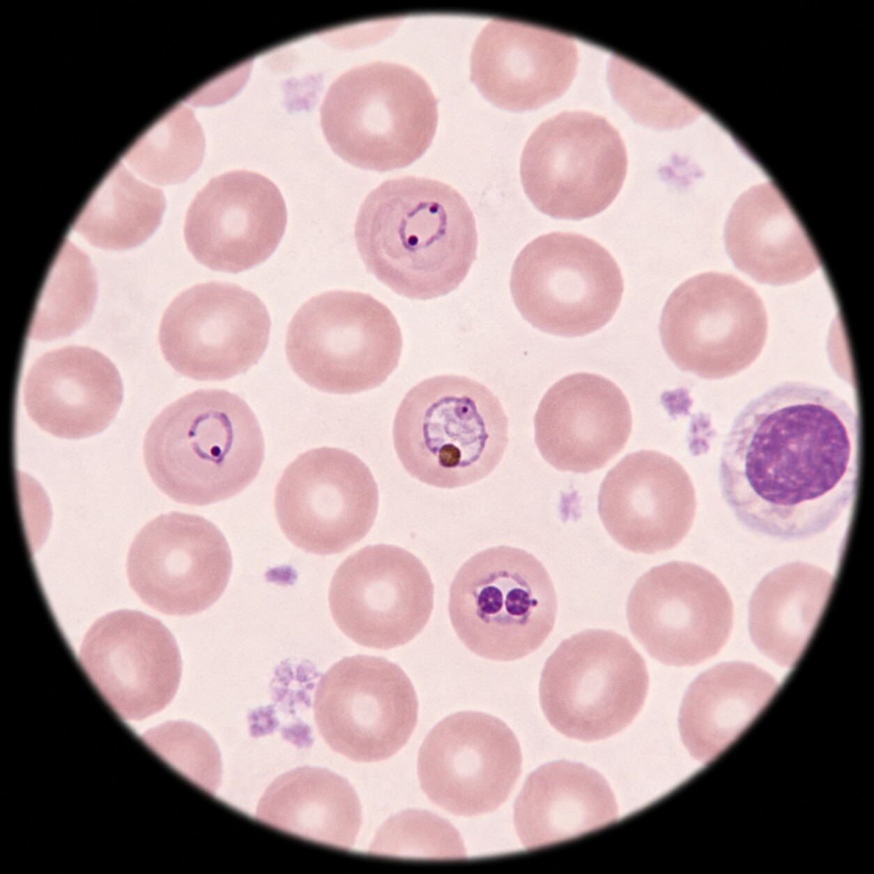 Close-up microscopy view of a Giemsa-stained thin blood smear showing ring-form malaria parasites inside red blood cells