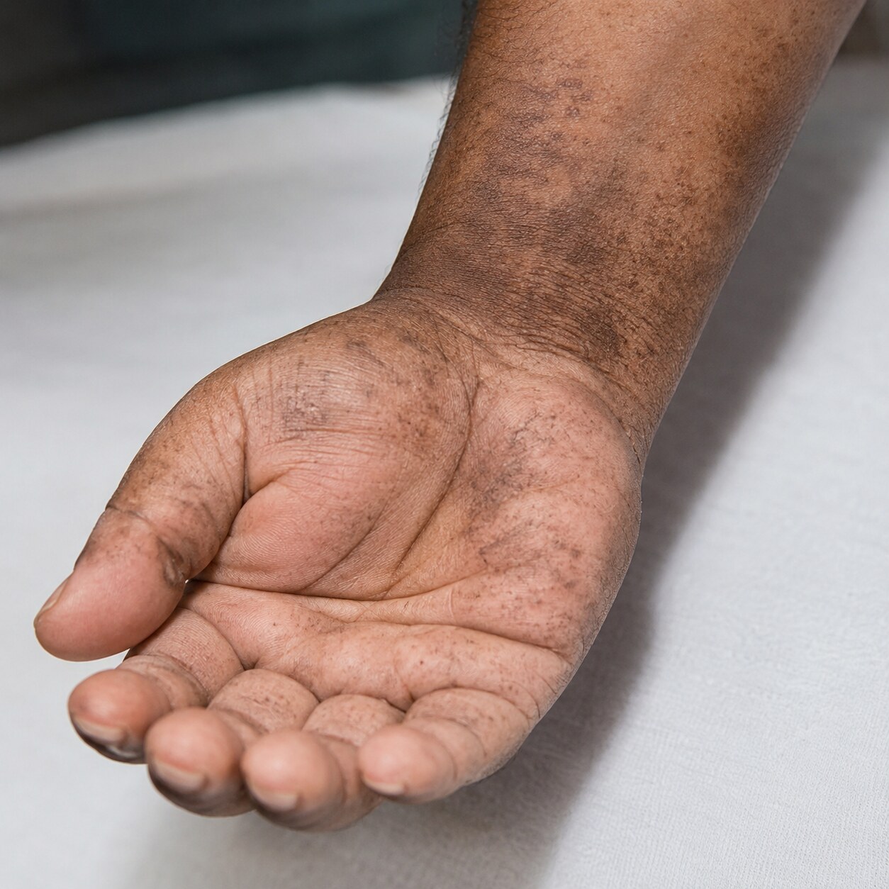 Close-up of subtle darkened skin pigmentation patches on the palms, a recognized sign of chronic long-term inorganic arsenic exposure