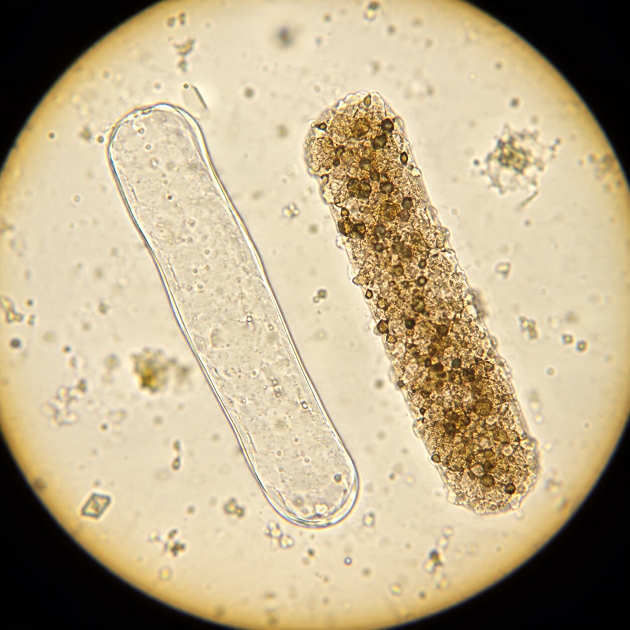 Microscope view comparing a smooth hyaline cast beside a darker speckled granular cast on one slide