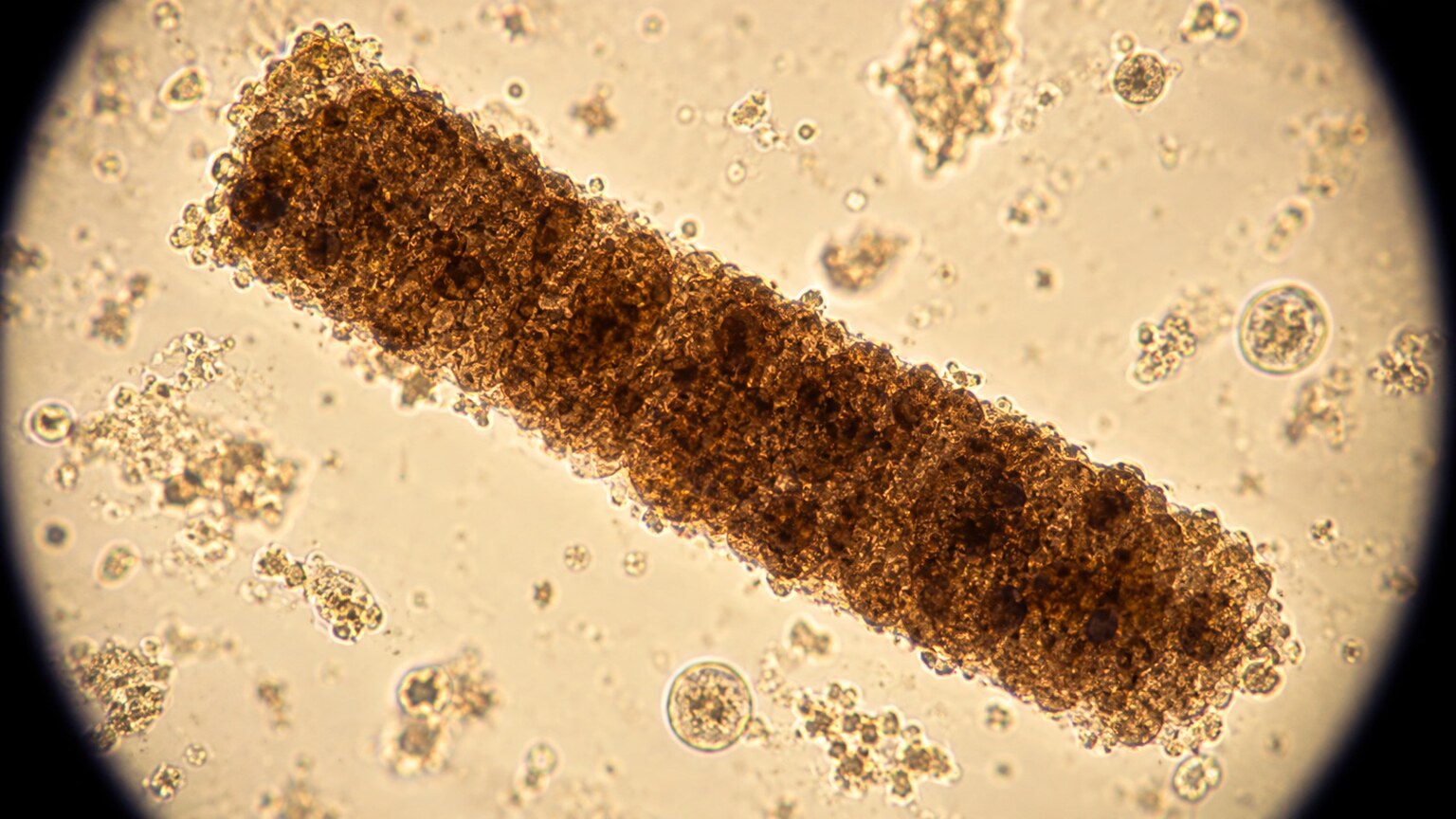 High-magnification microscope view of a dense, muddy brown granular cast associated with acute tubular necrosis