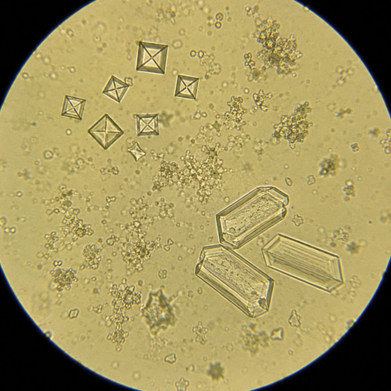 Circular microscope field of view showing envelope-shaped calcium oxalate and coffin-lid-shaped struvite crystals in urine sediment