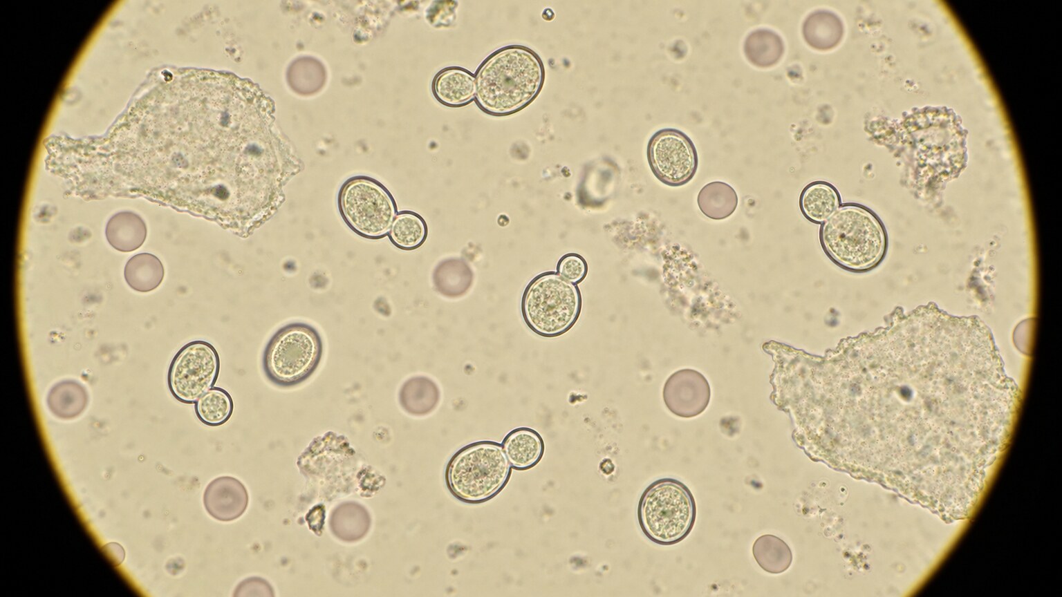 Microscope view of oval budding yeast cells scattered among urine sediment during a microscopic urinalysis