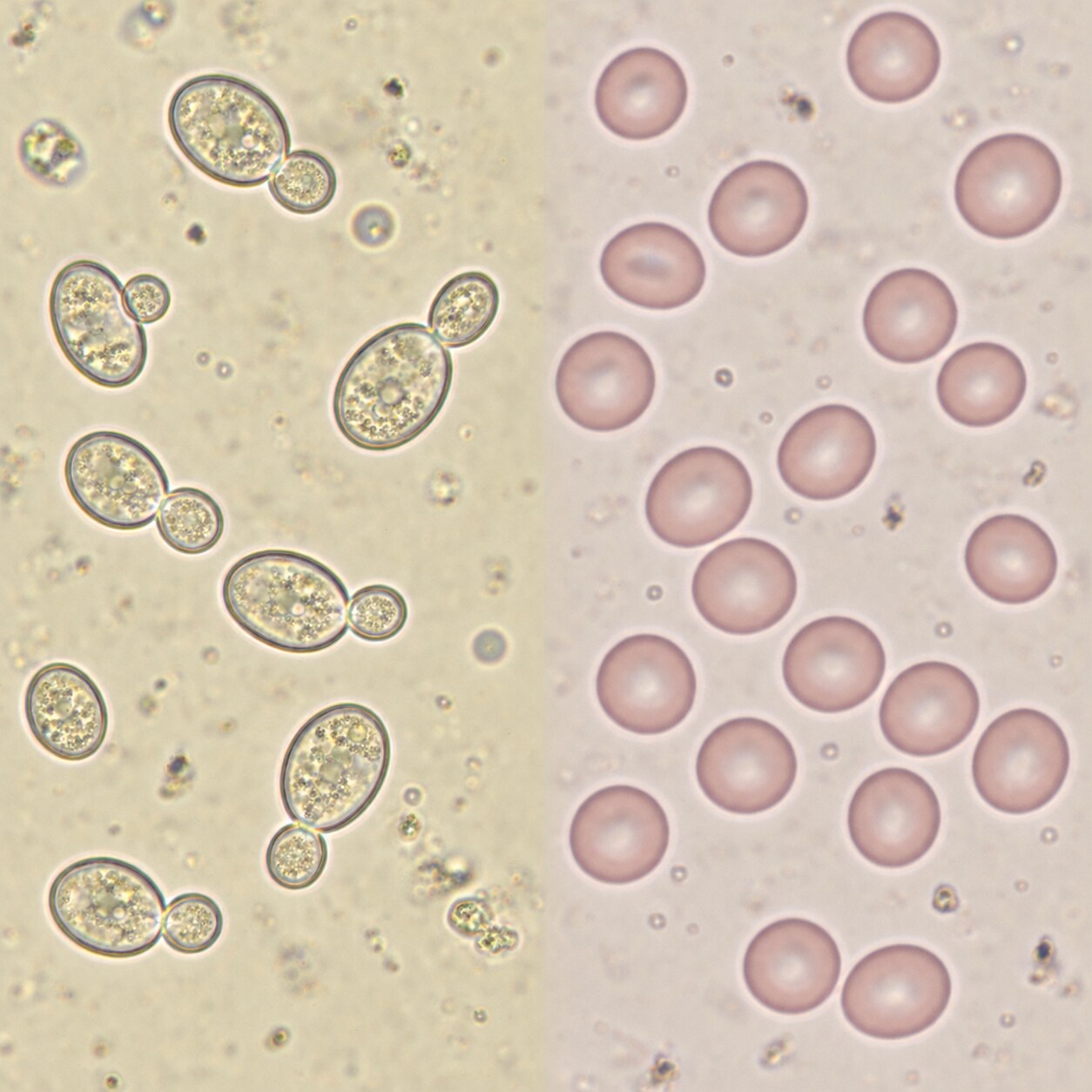 Side-by-side microscopic comparison of budding yeast cells and red blood cells in urine sediment