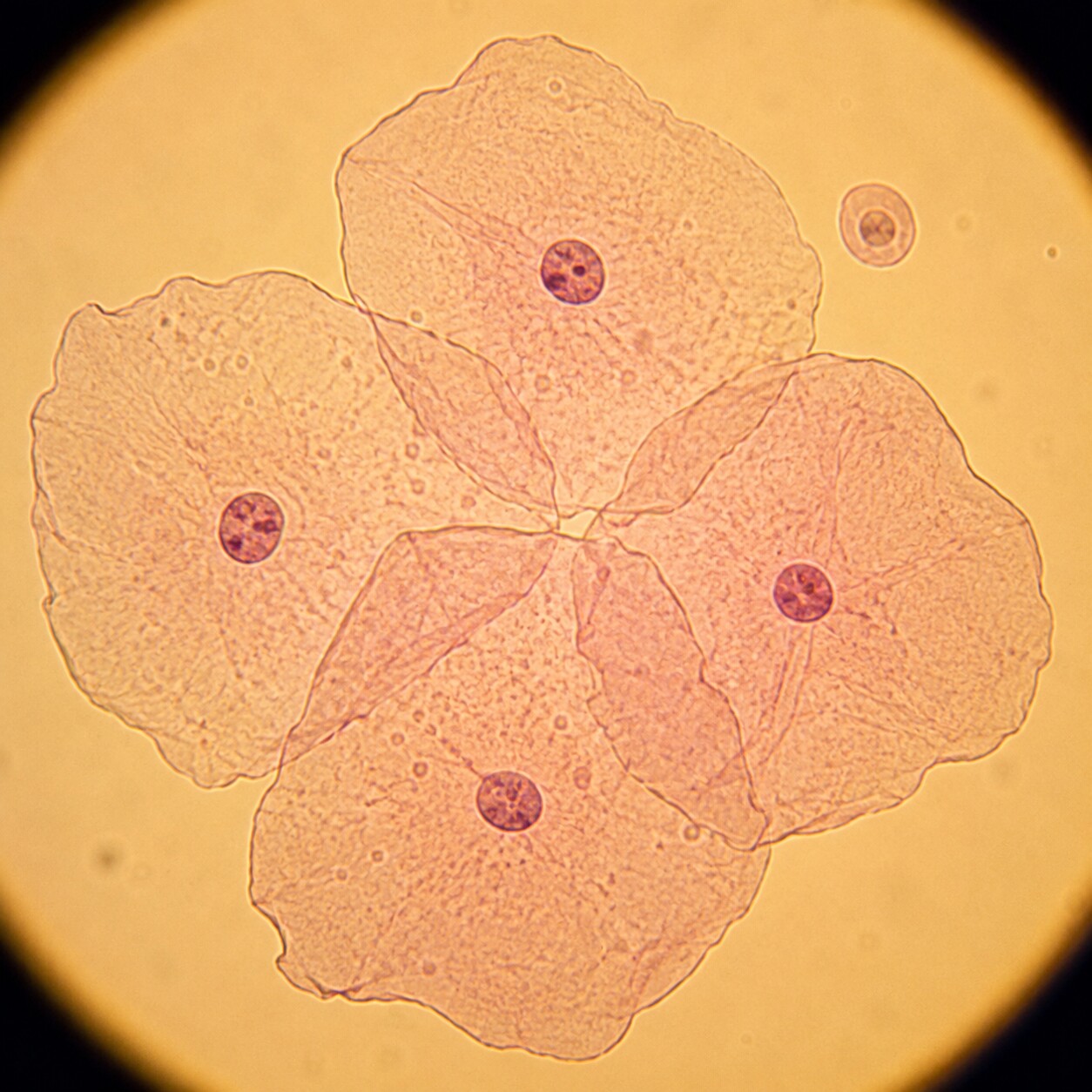 Microscopic view of large, flat squamous epithelial cells in a urine sediment sample