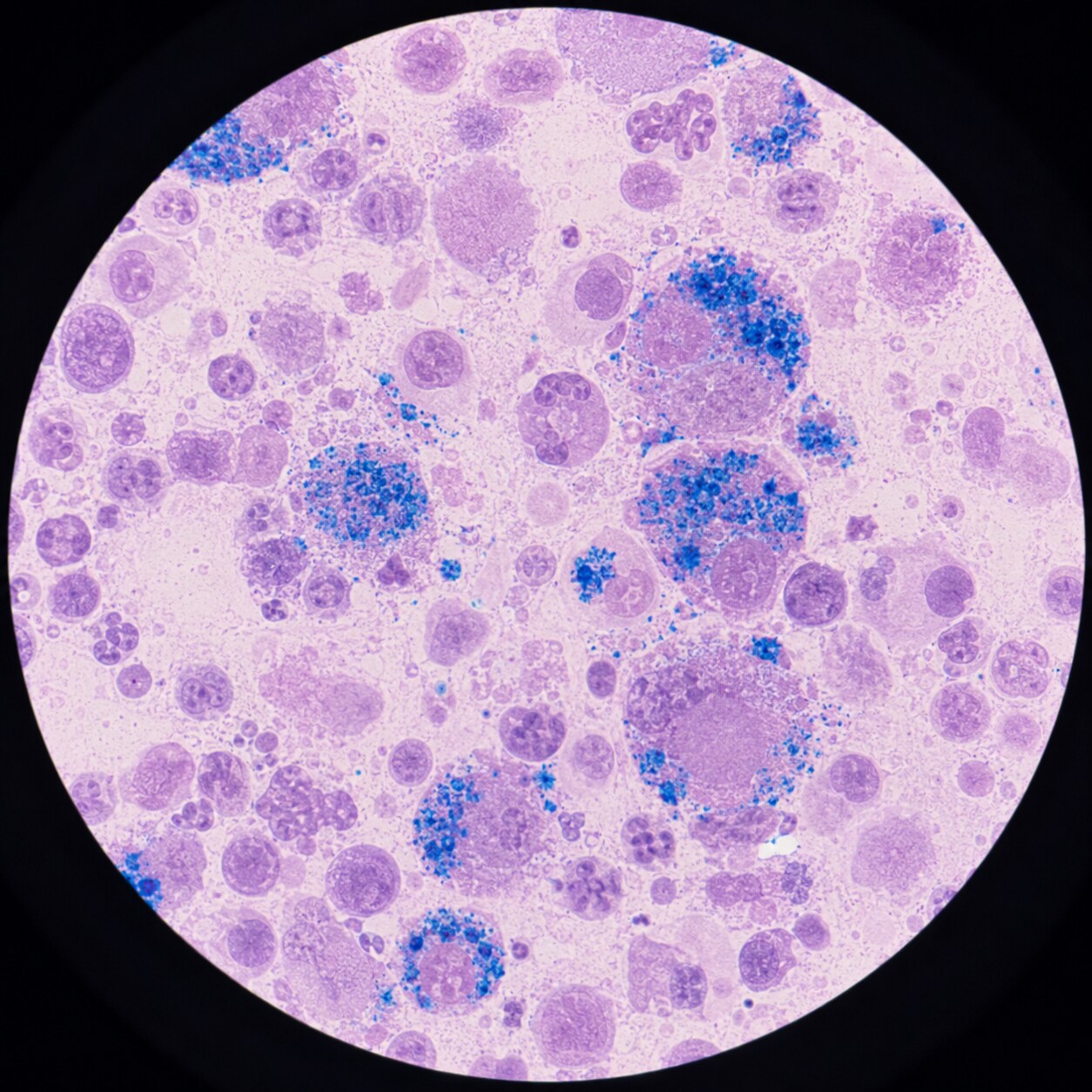 Microscope slide view of a Prussian blue iron stain on a bone marrow aspirate sample used to confirm ambiguous iron panel results